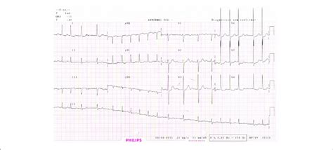 left ventricular overload on ekg